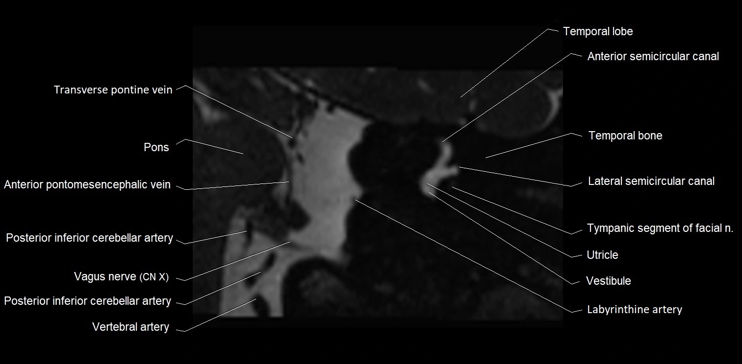 MRI Internal auditory meatus (IAM) coronal cross sectional labelled anatomy image 18.webp